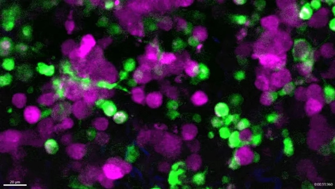 Científicos logran grabar por primera vez cómo células inmunes destruyen melanoma vivo